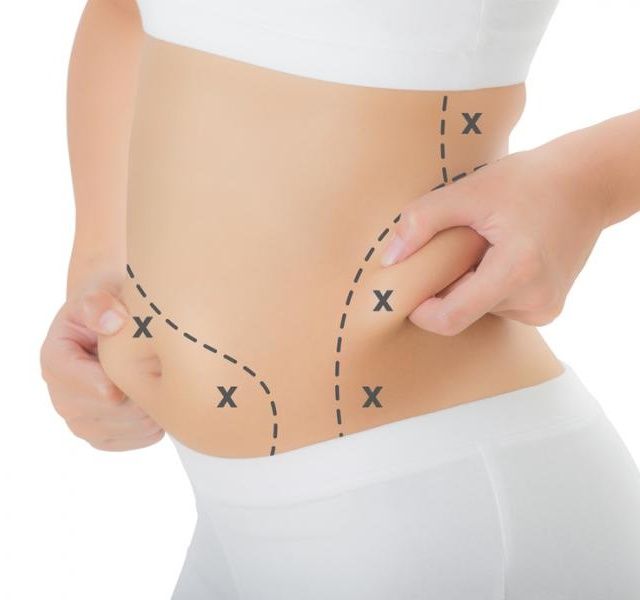 شفط دهون البطن وشد الترهلات: دليلكِ الشامل لنحت القوام في عيادة الرحيمي