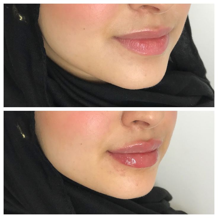 دليل شامل حول سعر فيلر تحديد الفك في الدمام لدى مستشفى الرحيمي