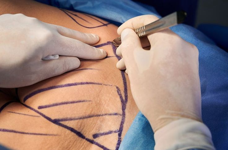 تصغير الصدر-  دليلك الشامل لاستعادة الراحة والتناسق في عيادة الرحيمي