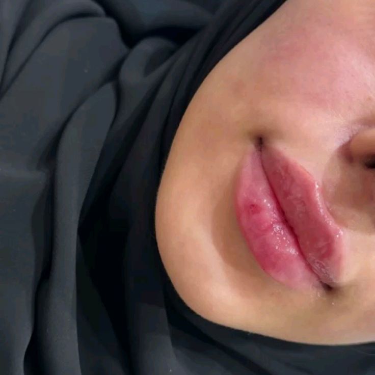 دليلك الشامل حول سعر الفيلر للشفايف في الخبر بمستشفى الرحيمي